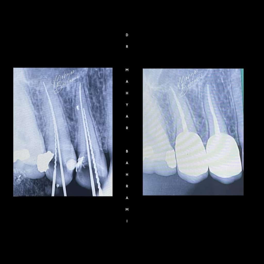 روکش زیرکونیا