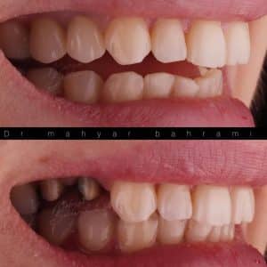 روکش زیرکونیا