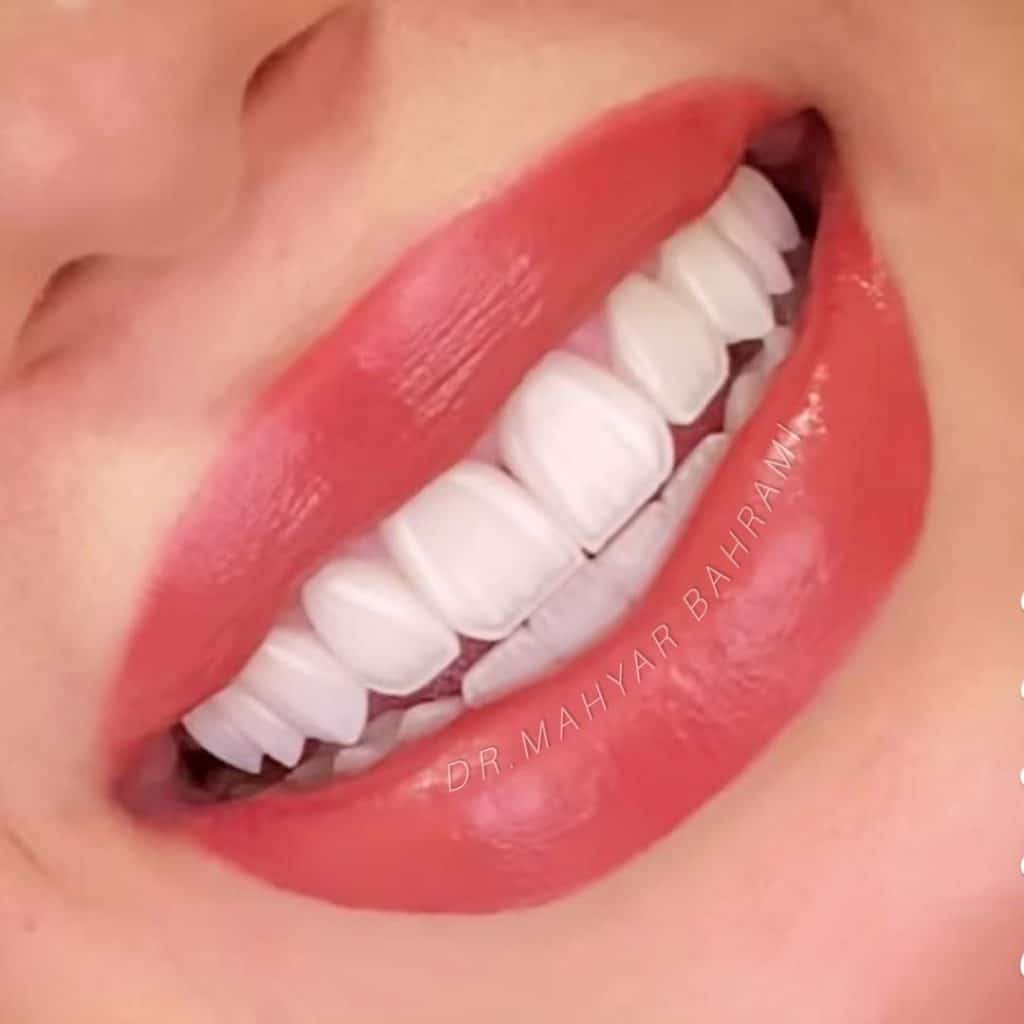 لمینت سرامیکی