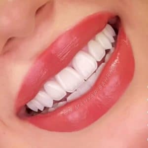 لمینیت سرامیکی