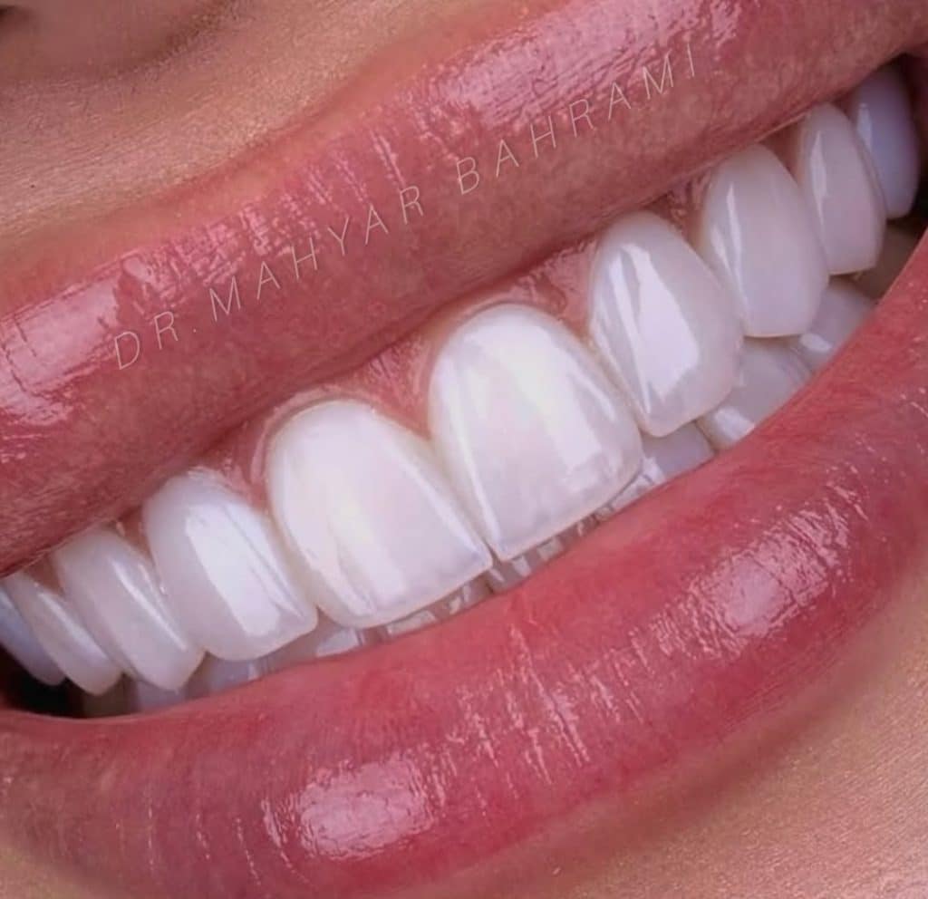 کامپوزیت لایرینگ ای پی اس ایوکولا