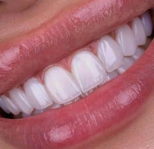 کامپوزیت لایرینگ ای پی اس ایوکولا کامپوزیت