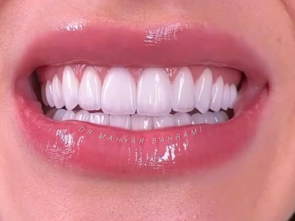 لمینیت سرامیکی