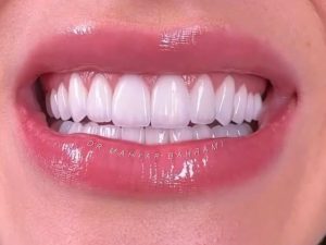 لمینیت سرامیکی